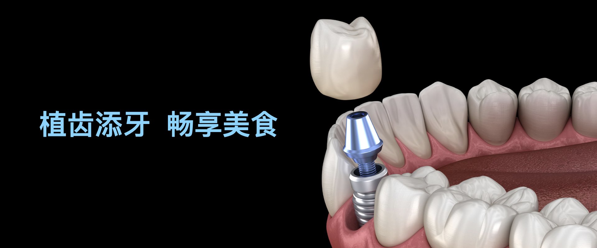 种植牙价格